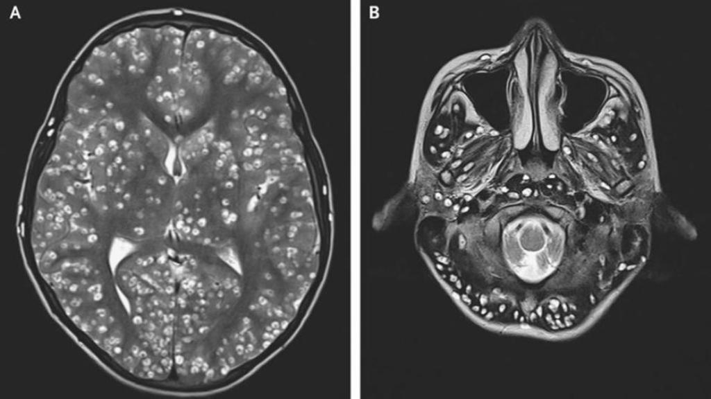 dolor de cabeza gusanos cerebro tenias India